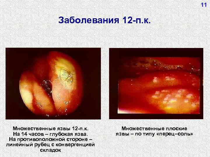 11 Заболевания 12 -п. к. Множественные язвы 12 -п. к. На 14 часов –