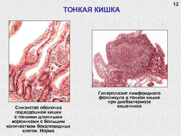 ТОНКАЯ КИШКА Слизистая оболочка подвздошной кишки с тонкими длинными ворсинками с большим количеством бокаловидных