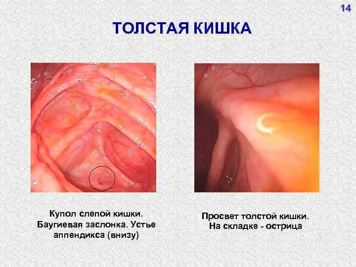14 ТОЛСТАЯ КИШКА Купол слепой кишки. Баугиевая заслонка. Устье аппендикса (внизу) Просвет толстой кишки.
