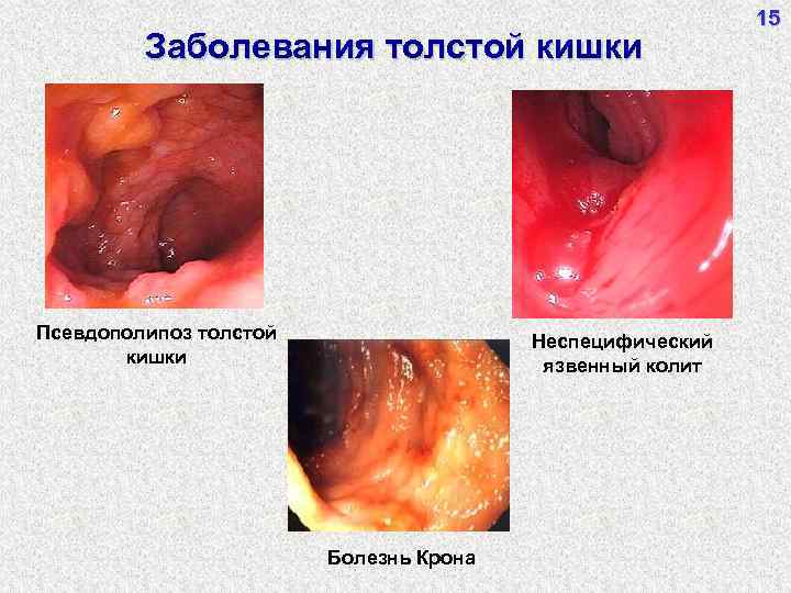 Заболевания толстой кишки Псевдополипоз толстой кишки Неспецифический язвенный колит Болезнь Крона 15 