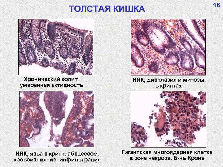 ТОЛСТАЯ КИШКА Хронический колит, умеренная активность НЯК, язва с крипт. абсцессом, кровоизлияние, инфильтрация НЯК,