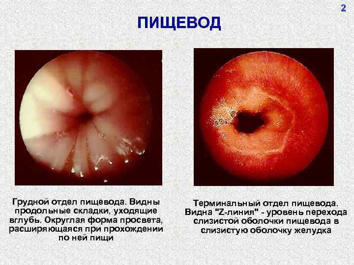 ПИЩЕВОД Грудной отдел пищевода. Видны продольные складки, уходящие вглубь. Округлая форма просвета, расширяющаяся при