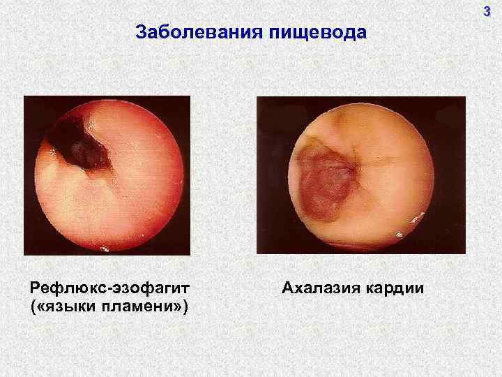 3 Заболевания пищевода Рефлюкс-эзофагит ( «языки пламени» ) Ахалазия кардии 