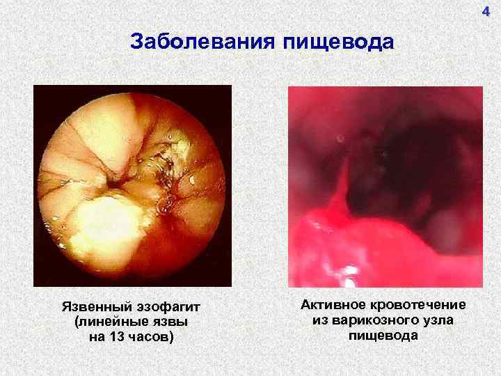 4 Заболевания пищевода Язвенный эзофагит (линейные язвы на 13 часов) Активное кровотечение из варикозного