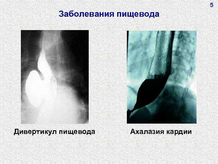 Какой из перечисленных симптомов является ведущим в рентгенологической картине ахалазии пищевода