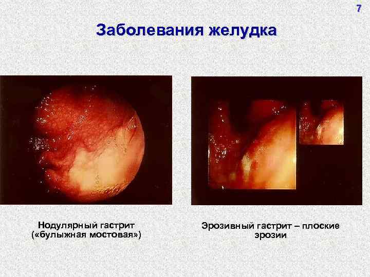 7 Заболевания желудка Нодулярный гастрит ( «булыжная мостовая» ) Эрозивный гастрит – плоские эрозии
