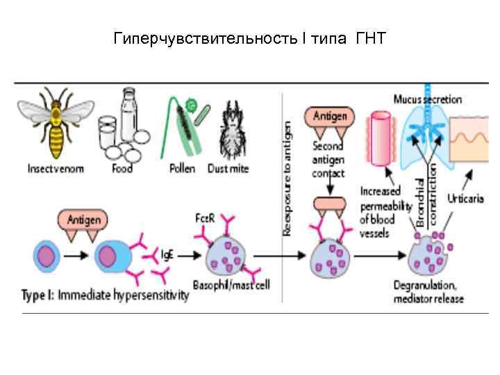 Гиперчувствительность 1 типа схема