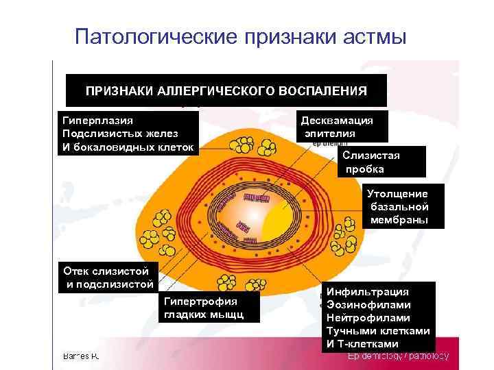 Патологические признаки астмы ПРИЗНАКИ АЛЛЕРГИЧЕСКОГО ВОСПАЛЕНИЯ Гиперплазия Подслизистых желез И бокаловидных клеток Десквамация эпителия