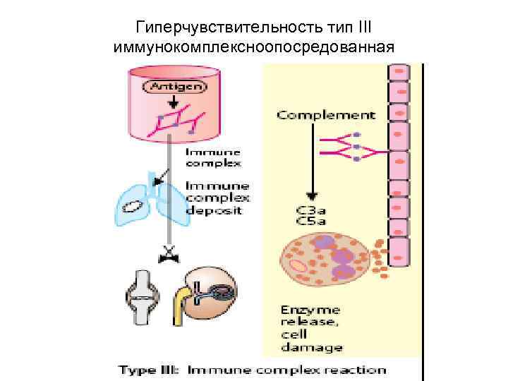 Гиперчувствительность тип III иммунокомплексноопосредованная 