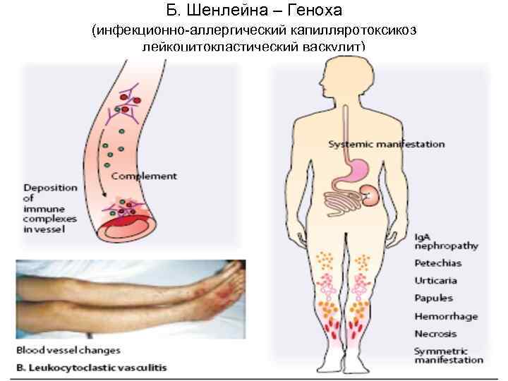 Б. Шенлейна – Геноха (инфекционно-аллергический капилляротоксикоз лейкоцитокластический васкулит) 