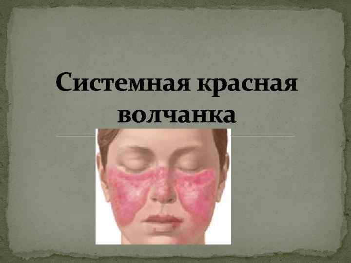 Системная красная волчанка 