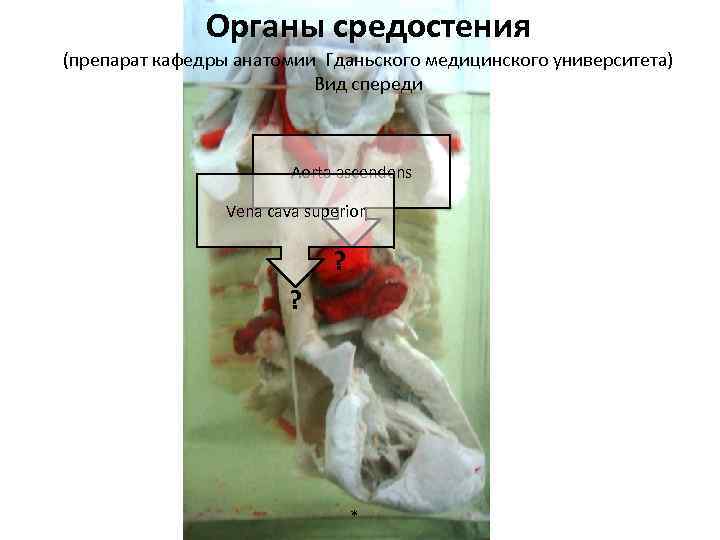 Органы средостения (препарат кафедры анатомии Гданьского медицинского университета) Вид спереди Аorta ascendens Vena cava