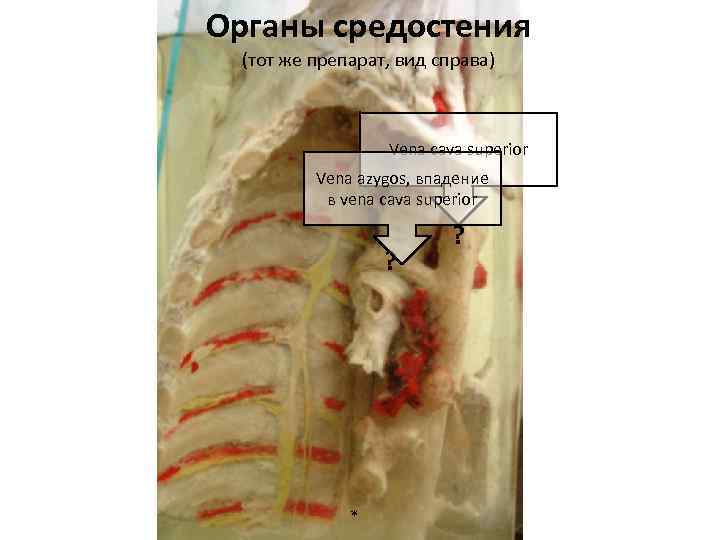 Органы средостения (тот же препарат, вид справа) Vena cava superior Vena azygos, впадение в