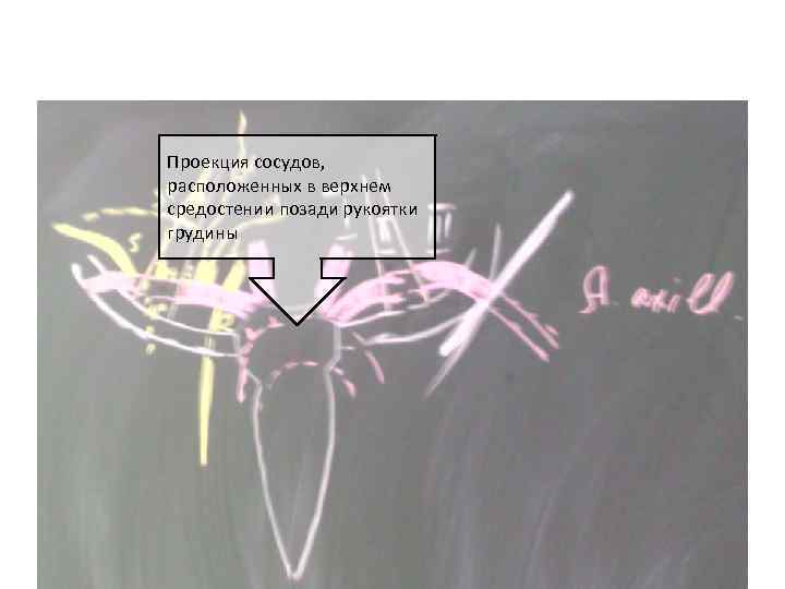 Проекция сосудов, расположенных в верхнем средостении позади рукоятки грудины 