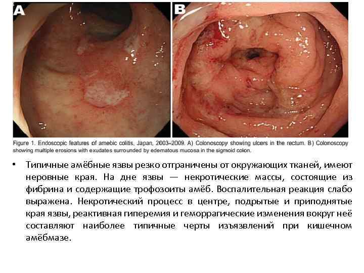  • Типичные амёбные язвы резко отграничены от окружающих тканей, имеют неровные края. На