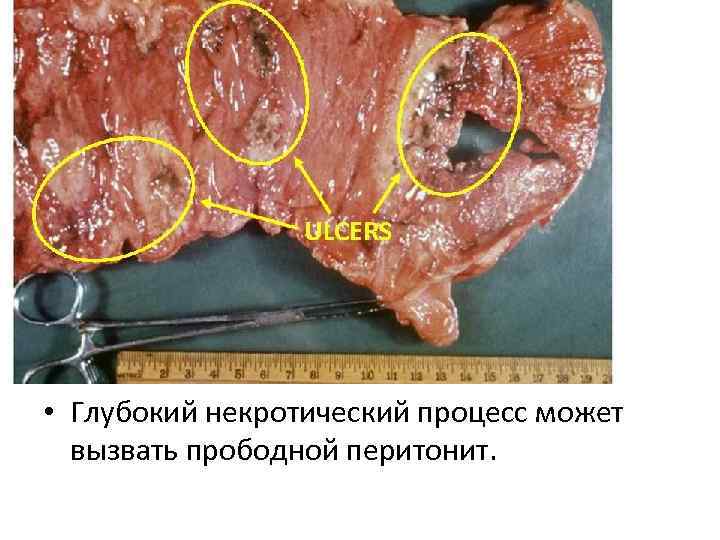  • Глубокий некротический процесс может вызвать прободной перитонит. 