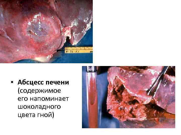  • Абсцесс печени (содержимое его напоминает шоколадного цвета гной) 