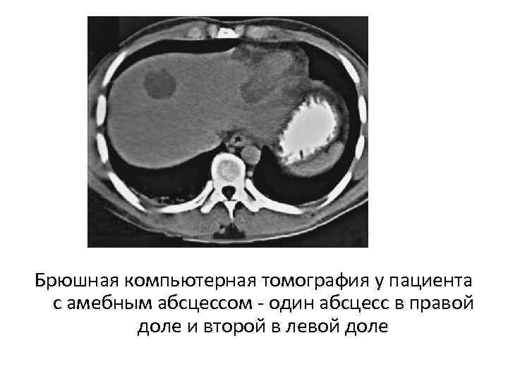 Брюшная компьютерная томография у пациента с амебным абсцессом один абсцесс в правой доле и