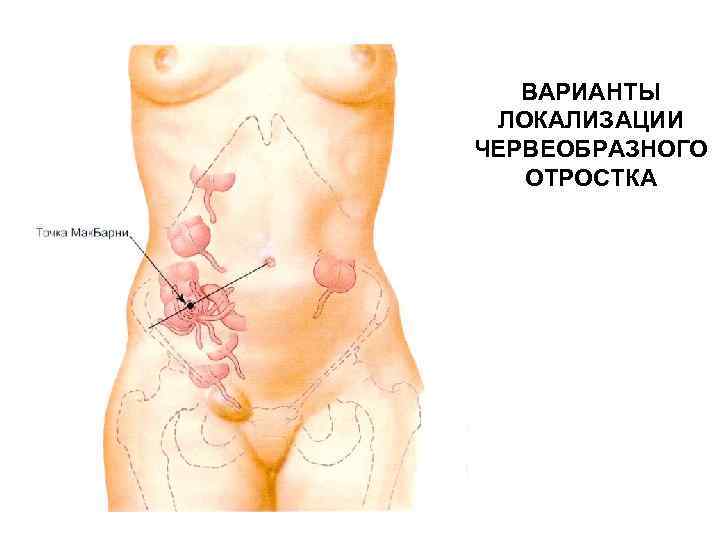 ВАРИАНТЫ ЛОКАЛИЗАЦИИ ЧЕРВЕОБРАЗНОГО ОТРОСТКА 