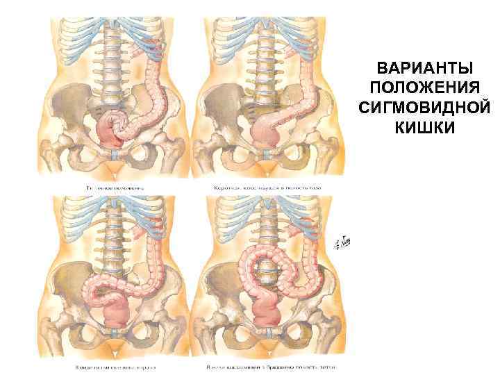 ВАРИАНТЫ ПОЛОЖЕНИЯ СИГМОВИДНОЙ КИШКИ 