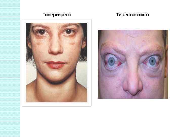Гипертиреоз Тиреотоксикоз 