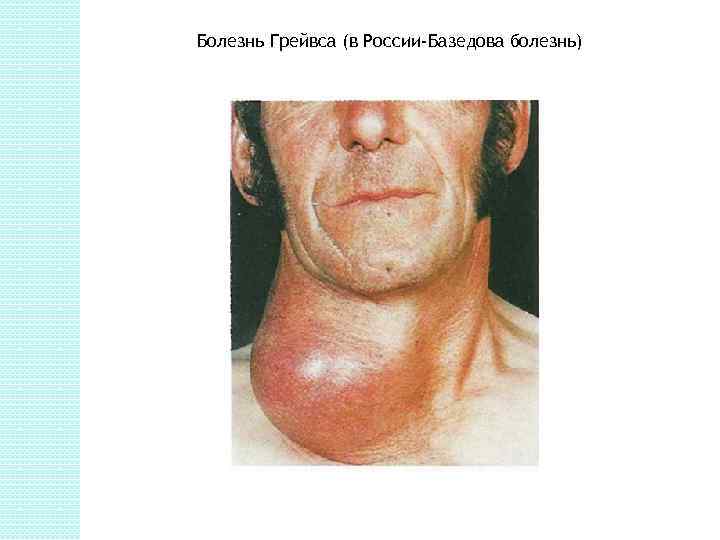 Болезнь Грейвса (в России-Базедова болезнь) 