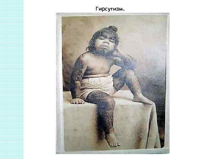 Гирсутизм. 