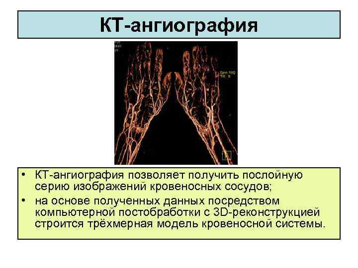 КТ-ангиография • КТ-ангиография позволяет получить послойную серию изображений кровеносных сосудов; • на основе полученных