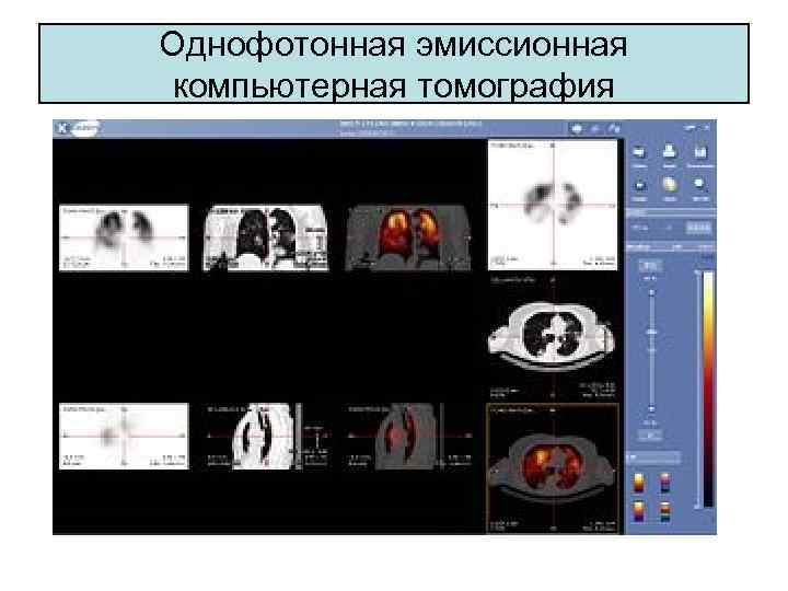 Однофотонная эмиссионная компьютерная томография 