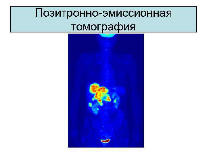 Позитронно-эмиссионная томография 