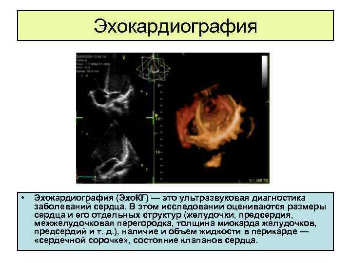 Эхокардиография • Эхокардиография (Эхо. КГ) — это ультразвуковая диагностика заболеваний сердца. В этом исследовании