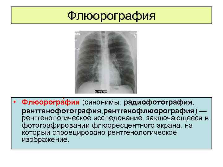 Флюорография • Флюорогра фия (синонимы: радиофотография, рентгенофотография, рентгенофлюорография) — рентгенологическое исследование, заключающееся в фотографировании