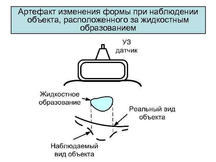 Артефакт изменения формы при наблюдении объекта, расположенного за жидкостным образованием 