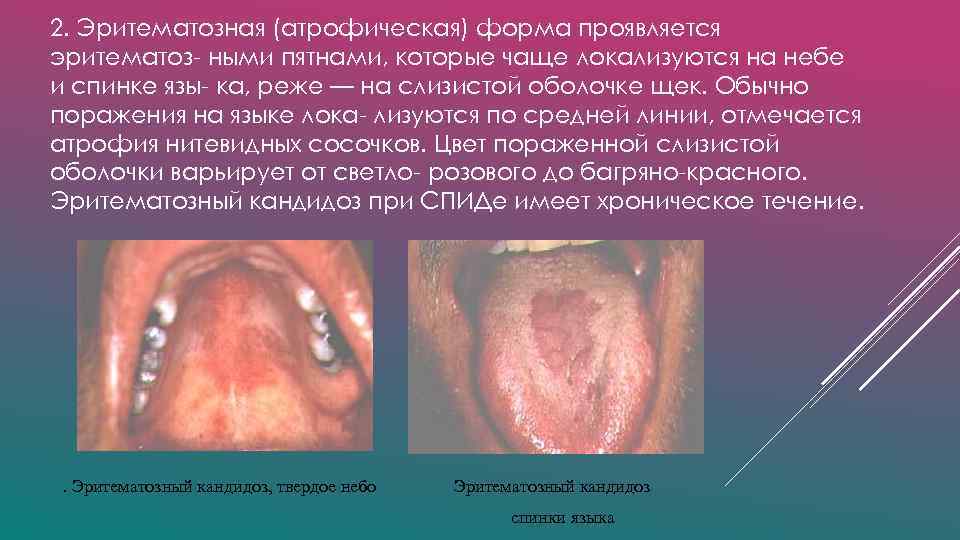 2. Эритематозная (атрофическая) форма проявляется эритематоз- ными пятнами, которые чаще локализуются на небе и