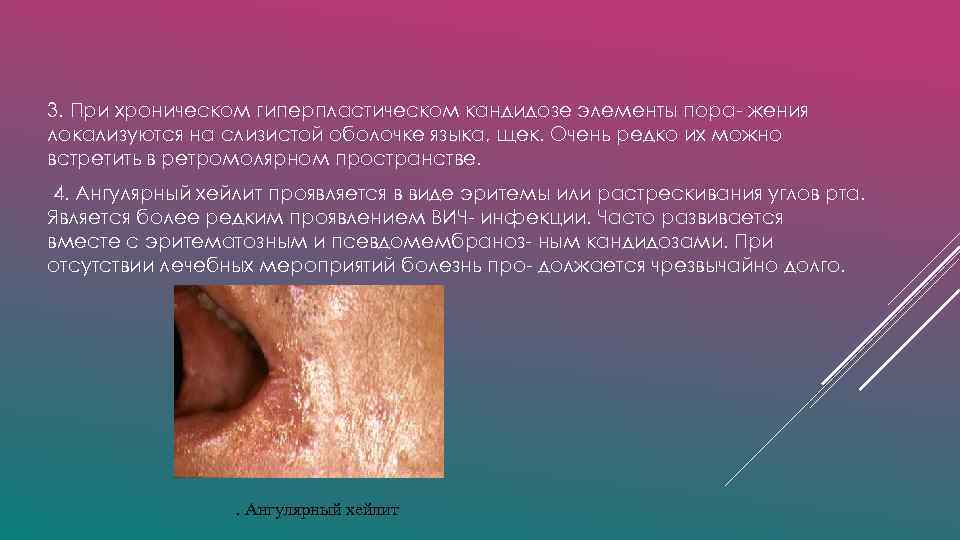 3. При хроническом гиперпластическом кандидозе элементы пора- жения локализуются на слизистой оболочке языка, щек.