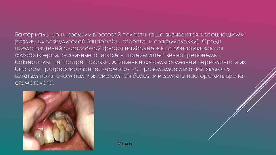 Бактериальные инфекции в ротовой полости чаще вызываются ассоциациями различных возбудителей (анаэробы, стрепто- и стафилококки).
