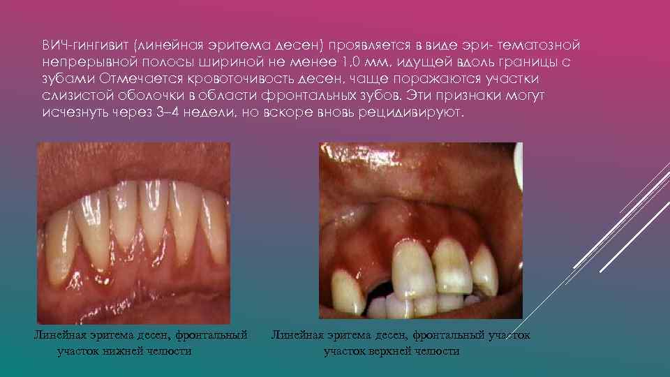 ВИЧ-гингивит (линейная эритема десен) проявляется в виде эри- тематозной непрерывной полосы шириной не менее