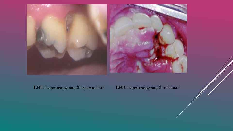 ВИЧ-некротизирующий периодонтит ВИЧ-некротизирующий гингивит 