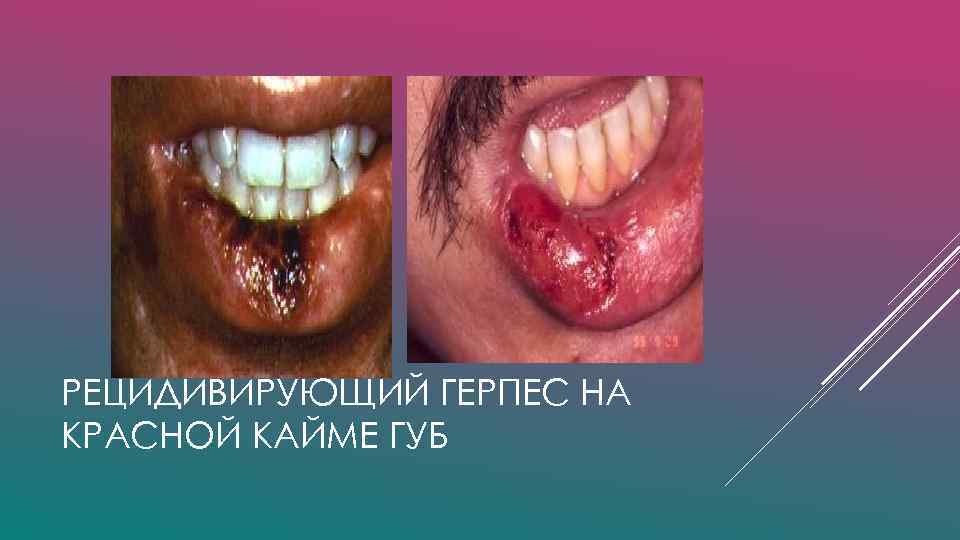РЕЦИДИВИРУЮЩИЙ ГЕРПЕС НА КРАСНОЙ КАЙМЕ ГУБ 