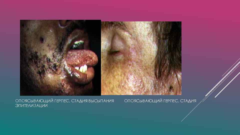 ОПОЯСЫВАЮЩИЙ ГЕРПЕС, СТАДИЯ ВЫСЫПАНИЯ ЭПИТЕЛИЗАЦИИ ОПОЯСЫВАЮЩИЙ ГЕРПЕС, СТАДИЯ 