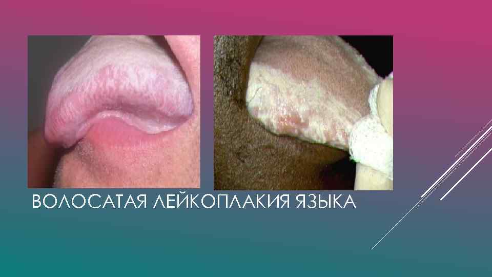 ВОЛОСАТАЯ ЛЕЙКОПЛАКИЯ ЯЗЫКА 