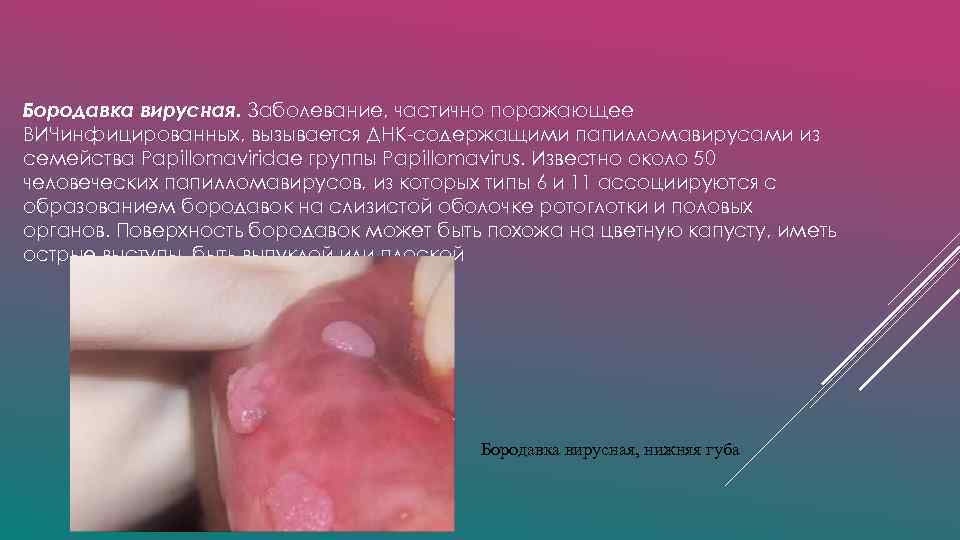 Бородавка вирусная. Заболевание, частично поражающее ВИЧинфицированных, вызывается ДНК-содержащими папилломавирусами из семейства Papillomaviridae группы Papillomavirus.