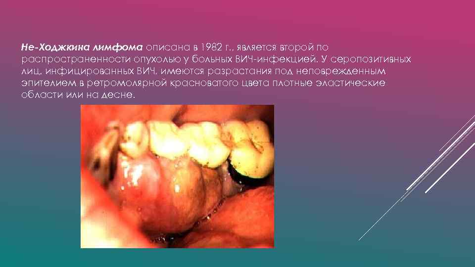 Не-Ходжкина лимфома описана в 1982 г. , является второй по распространенности опухолью у больных