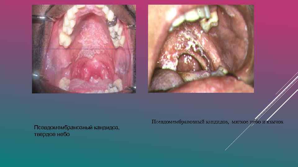 Псевдомембранозный кандидоз, твердое небо Псевдомембранозный кандидоз, мягкое небо и язычок 