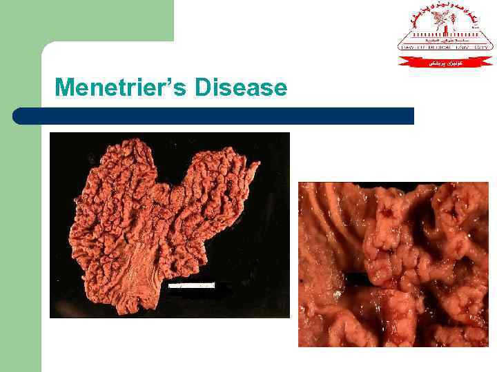 Menetrier’s Disease 