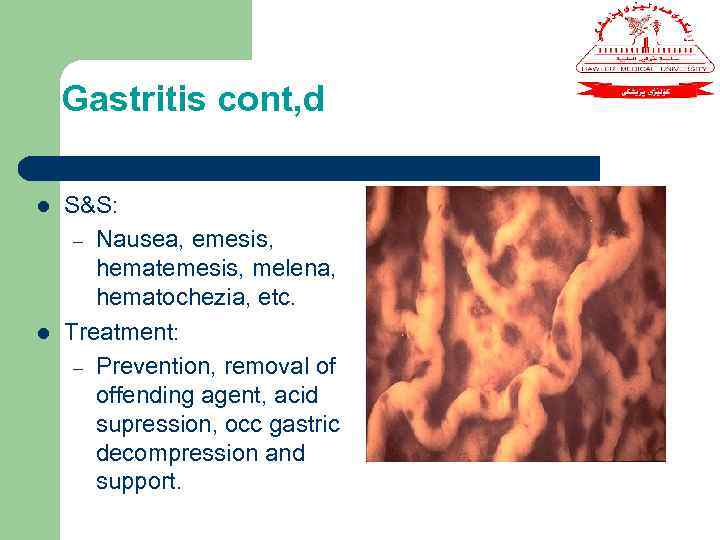 Gastritis cont, d l l S&S: – Nausea, emesis, hematemesis, melena, hematochezia, etc. Treatment: