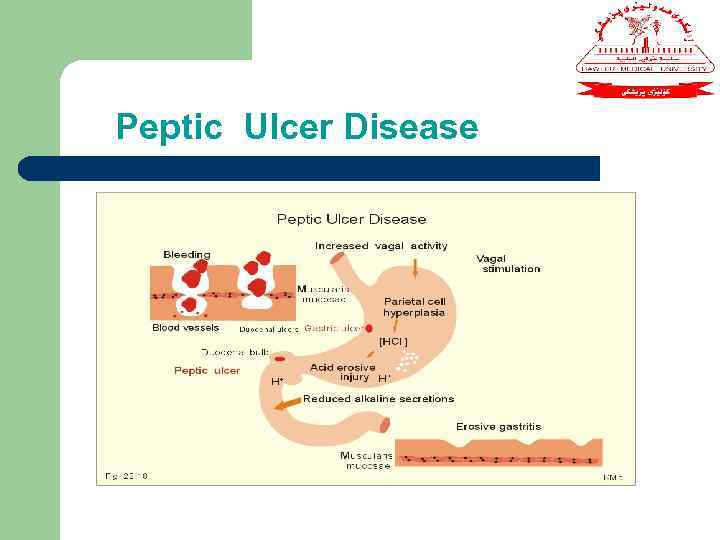 Peptic Ulcer Disease 