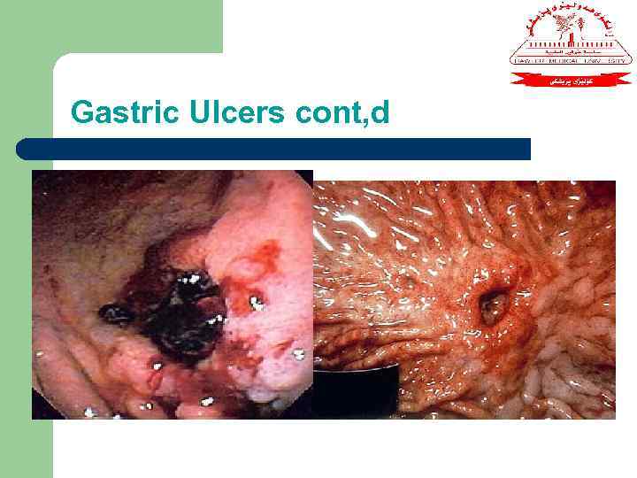 Gastric Ulcers cont, d 