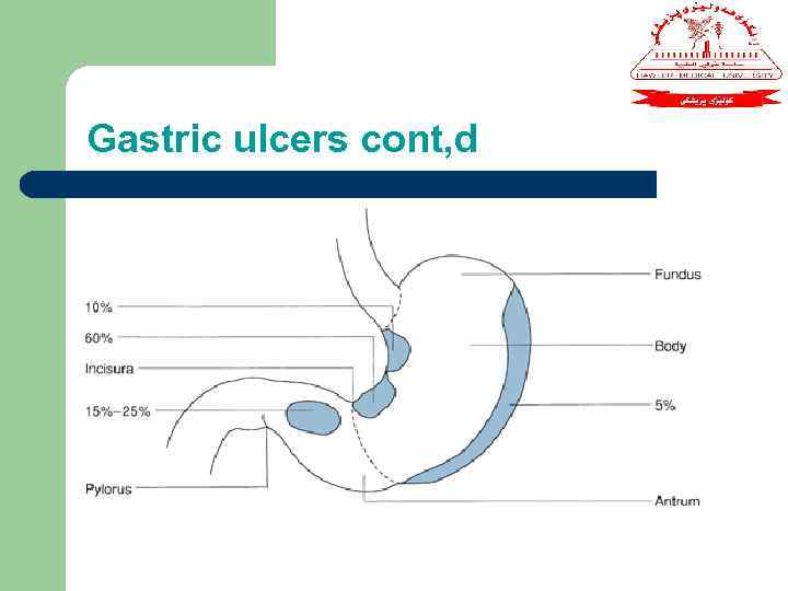 Gastric ulcers cont, d 