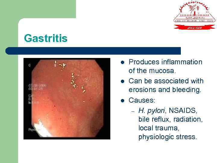 Gastritis l l l Produces inflammation of the mucosa. Can be associated with erosions